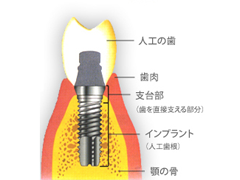 インプラントとは？