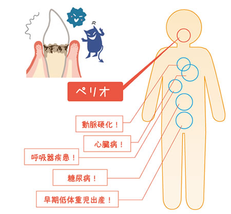 ペリオが関係する病気