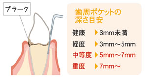 歯周ポケットの深さ目安