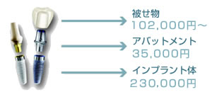 インプラント費用