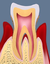 全身疾患にもつながる歯周病
